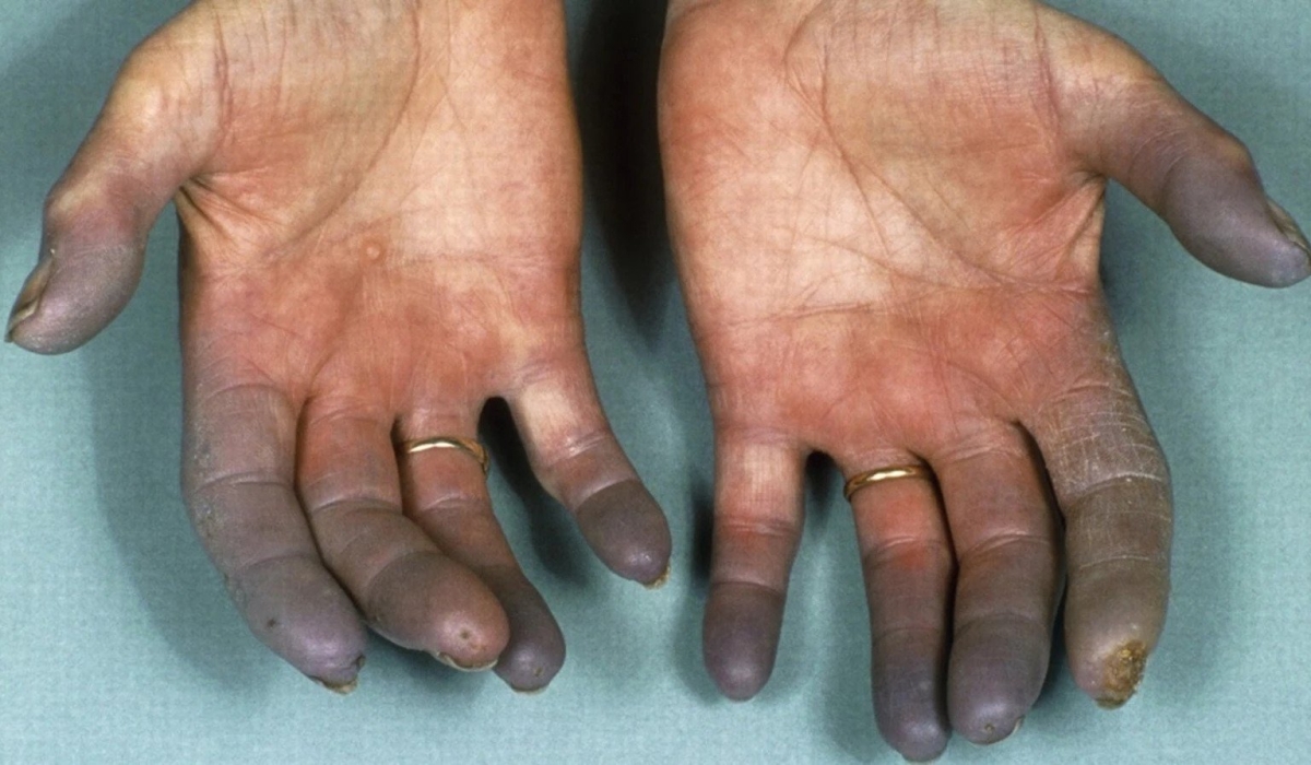 Buerger’s Disease, also known as thromboangitis obliterans, is a chronic and disabling condition that ultimately leads to the loss of one or more limbs. Internet