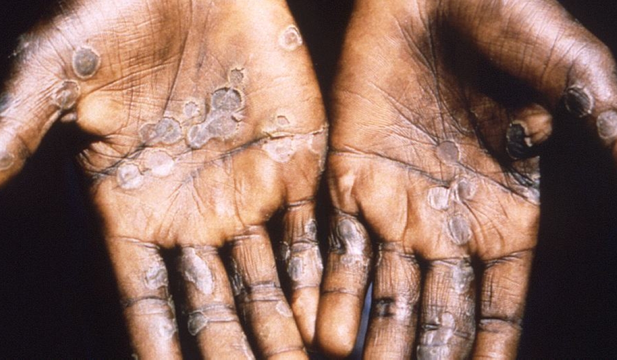 Mpox, formerly called monkeypox, is a viral infection and can be deadly. It is reported that the current outbreak has been driven by sexual transmission but there is evidence this strain can also be passed on through close skin-to-skin contact.