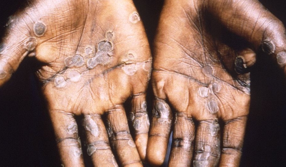 Mpox, formerly called monkeypox, is a viral infection and can be deadly. Rwanda confirmed two cases of mpox on Saturday, July 27, the first outbreak of the infection in the country.