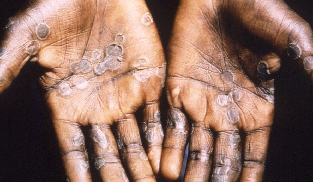 Mpox, formerly called monkeypox, is a viral infection and can be deadly. Rwanda confirmed two cases of mpox on Saturday, July 27, the first outbreak of the infection in the country.