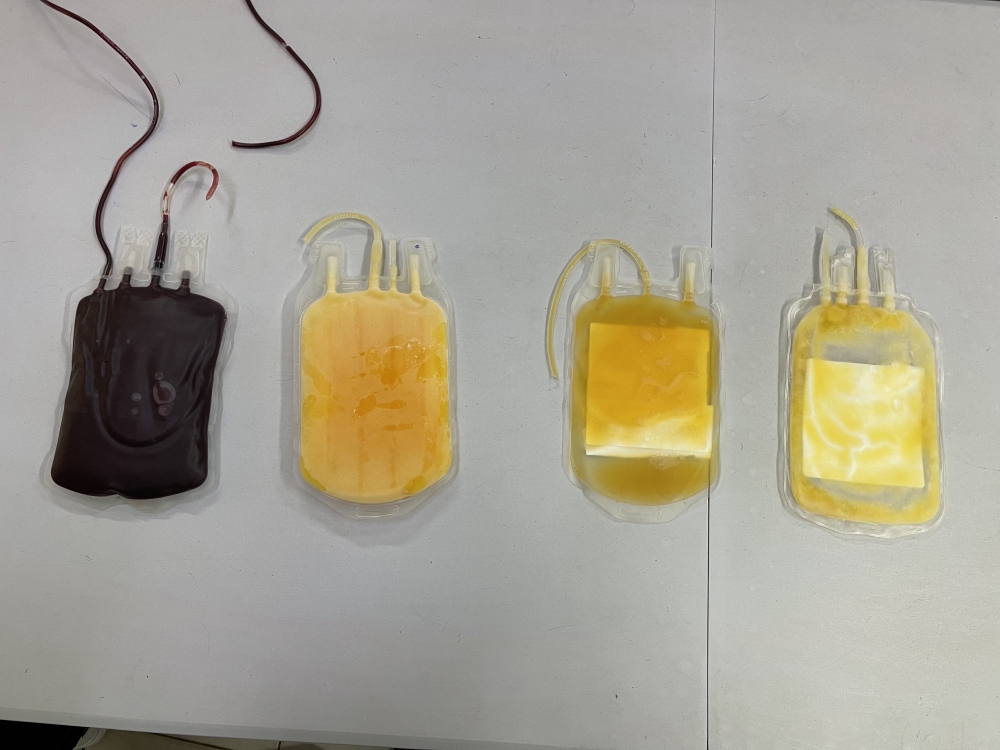 Various blood components in dedicated bags from left to right: red blood cells, plasma, platelets, and cryoprecipitates, at RBC’s Blood Transfusion Division in Kigali, on July 30, 2024. Rwanda plans to sell plasma surplus to address production cost and ease access to derived lifesaving medication.