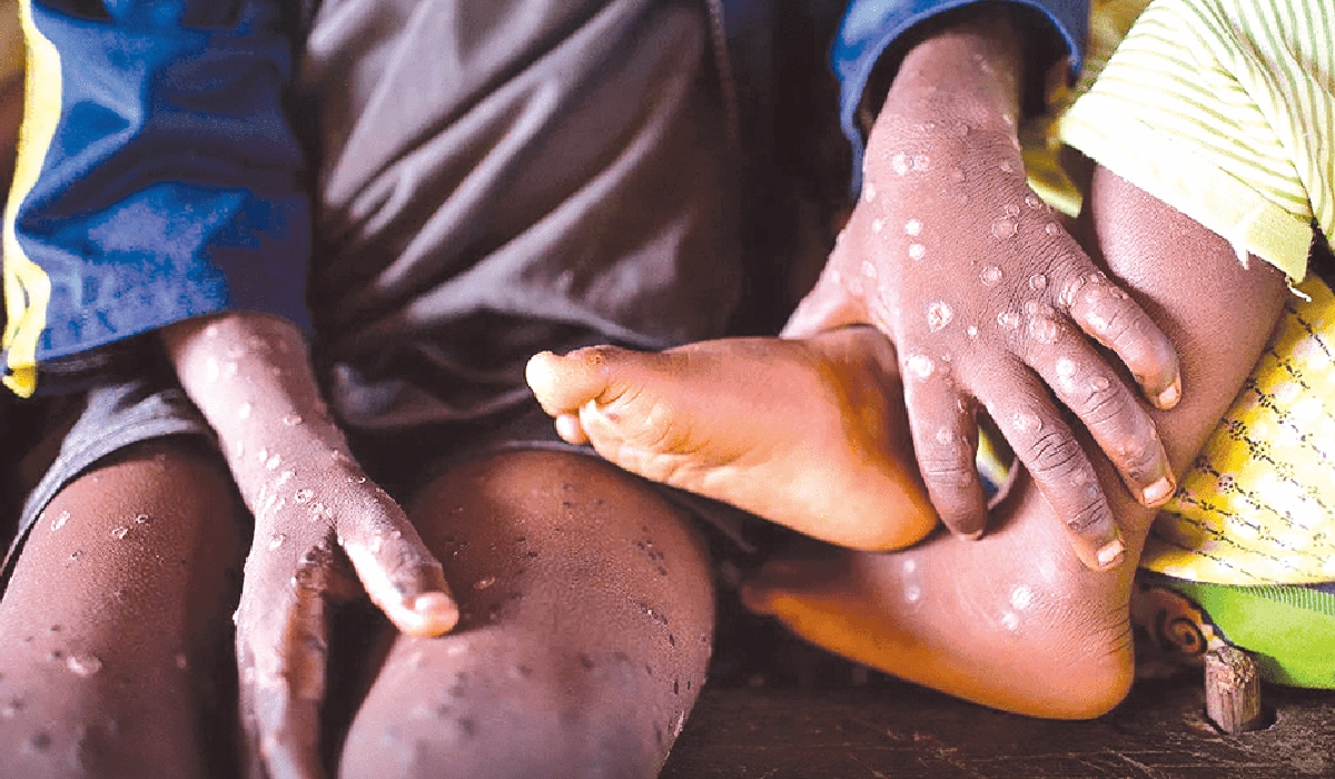 Skin rash is a distinctive symptom of Mpox. Rwanda has confirmed two cases of the virus as of July 28, 2024. Net photo