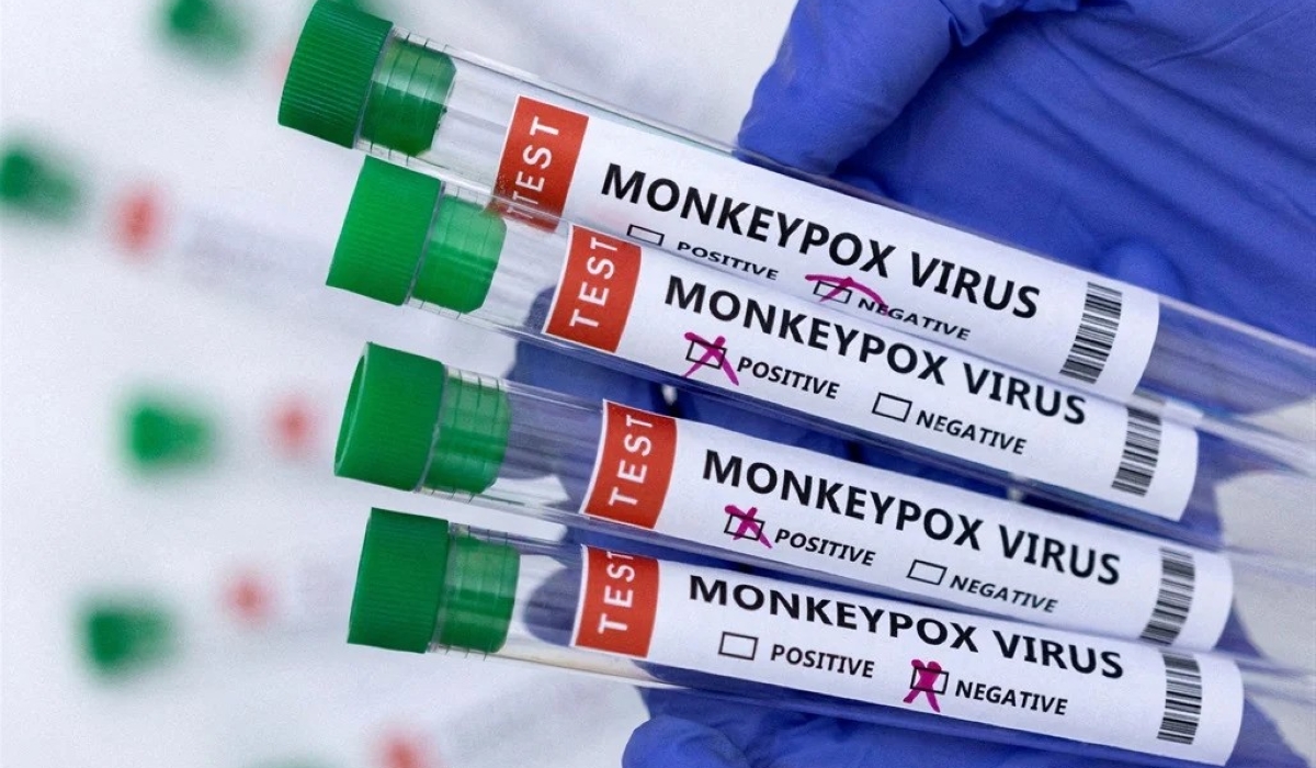 Mpox, a viral illness caused by the monkeypox virus.