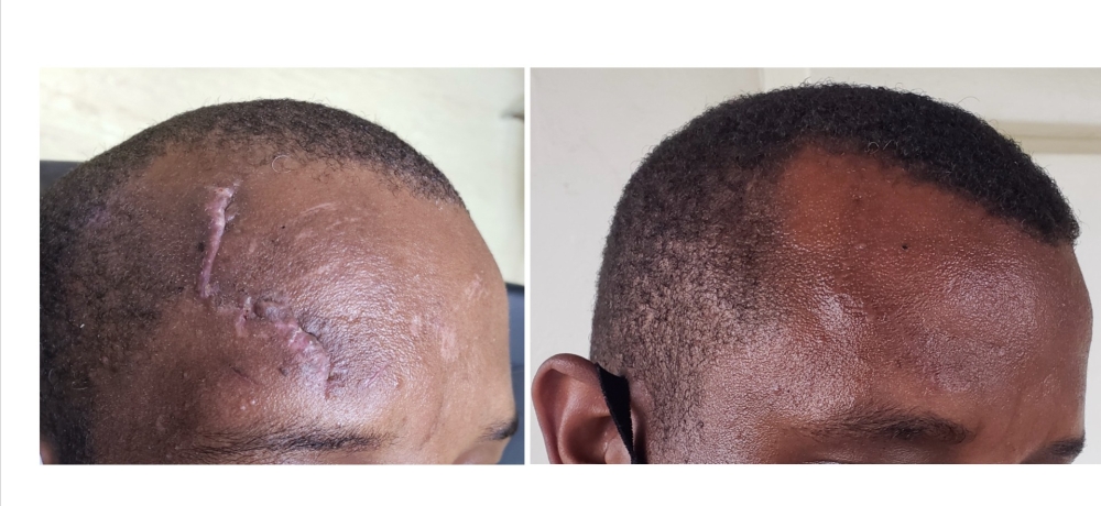 A picture showing a conspicuous forehead scar before and after plastic surgery scar revision. Courtesy