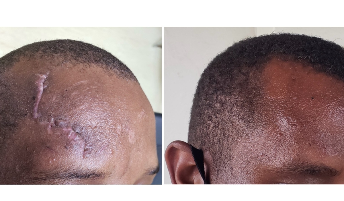 A picture showing a conspicuous forehead scar before and after plastic surgery scar revision. Courtesy