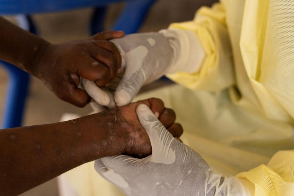 DR Congo reported 35 new Mpox-related deaths.