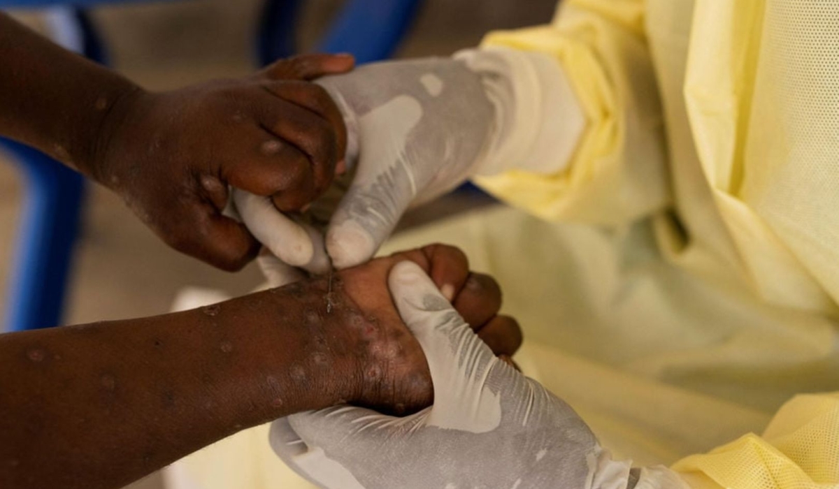 DR Congo reported 35 new Mpox-related deaths.