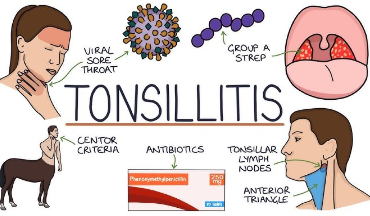 Tonsillitis is primarily caused by bacterial or viral infections, resulting in painful and swollen tonsils, high fever, nasal congestion, cough, and possibly difficulty breathing.