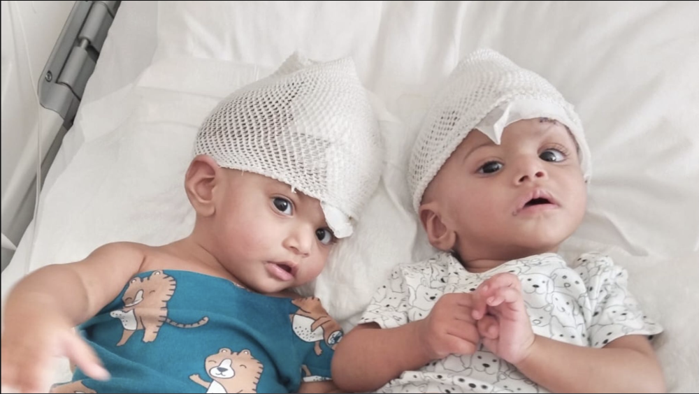 Rare conjoined twin girls separated after 14-hour operation using mixed reality.