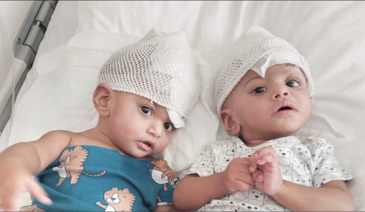 Rare conjoined twin girls separated after 14-hour operation using mixed reality.