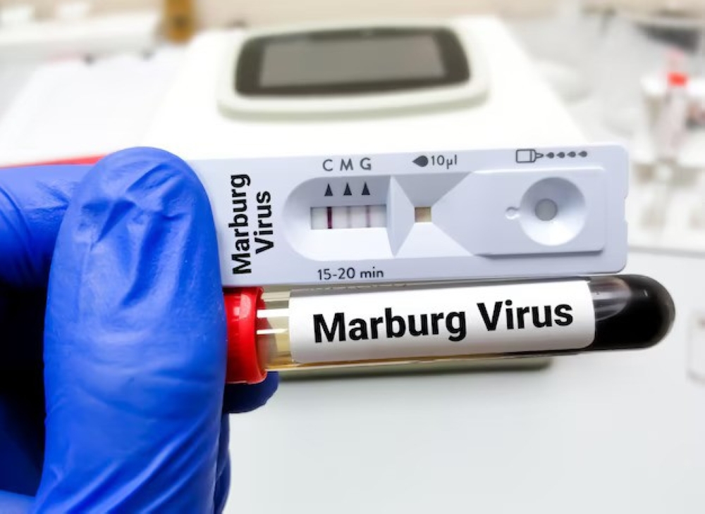 The death toll from the Marburg virus increased to 11 after one person dies from the disease on Wednesday, October 2. Courtesy.