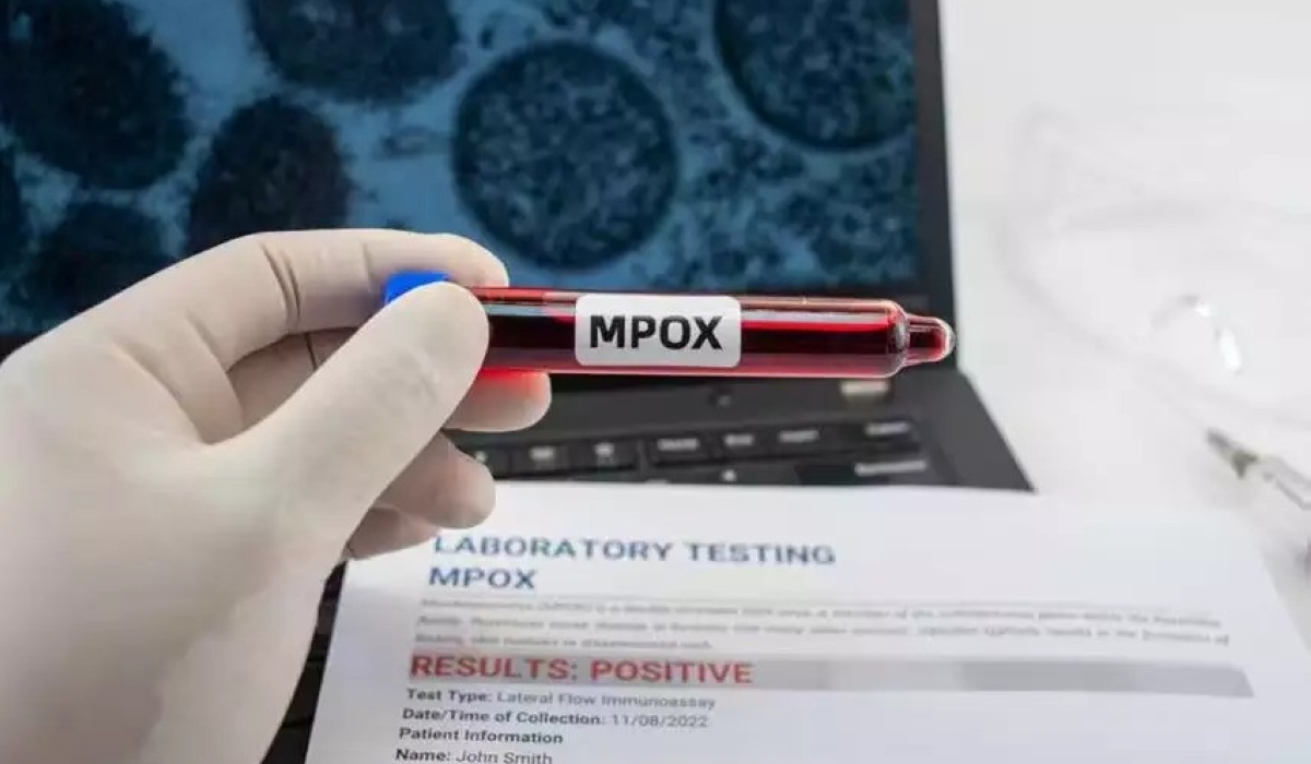 The first case of the new mpox variant has been detected in Germany, the Robert Koch Institute (RKI) for public health said on Tuesday.