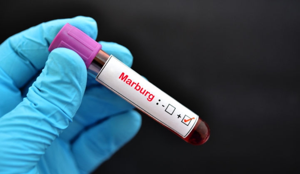 A positive Marburg test. Rwanda confirmed the outbreak of the virus in the country in September.