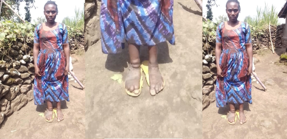 Françoise Mukandutiye, a 33-year-old resident of Kimonyi Sector in Musanze District, has spent nearly two decades battling podoconiosis. Courtesy