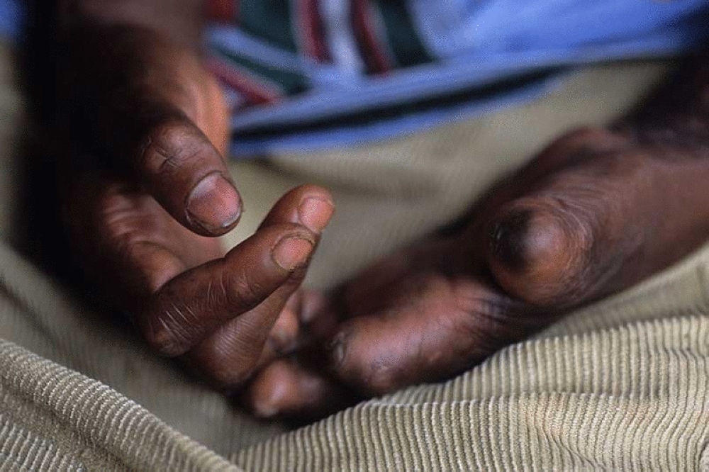 Rwanda is among countries that are in the process of eradicating leprosy. Courtesy