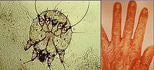 L-R : Scabie Mite ; Scabies rash and excoriation on the hand (Internet Photo)