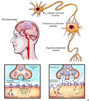 When the brain suffers an injury, such as a stroke, neurons release glutamate onto nearby neurons, which become excited and overloaded with calcium, after which they die (left). Normal neurotransmission. (Net photo)