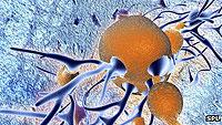 Plaques, in brown, form around brain cells, in blue, which kills parts of the brain. Net photo