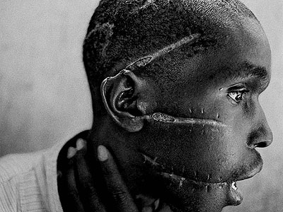 Many were lucky to escape death in 1994 but the brutality of the mass slaughter saw them live with haunting scar. Psychologist say such scars have had adverse effects on mental health of the survivors. (internet photo)